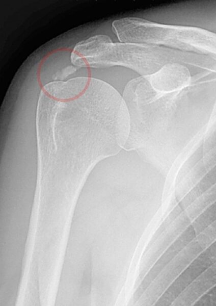 石灰沈着性腱板炎